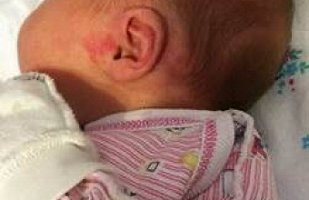 Младенческая гемангиома: риски, лечение и мнение врачей